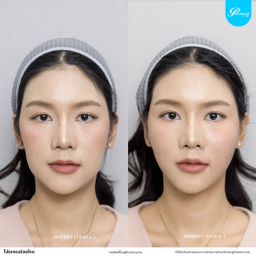 patrawutclinic-ร้อยไหม02
