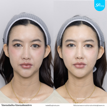patrawutclinic-ร้อยไหม03