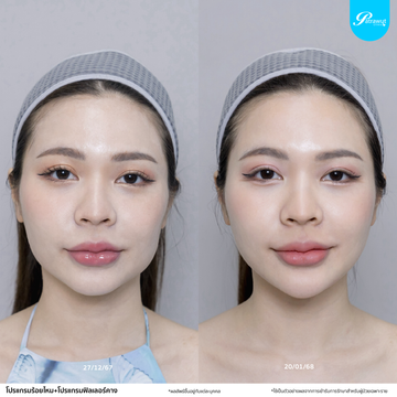 patrawutclinic-ร้อยไหม04