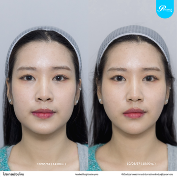 patrawutclinic-ร้อยไหม05