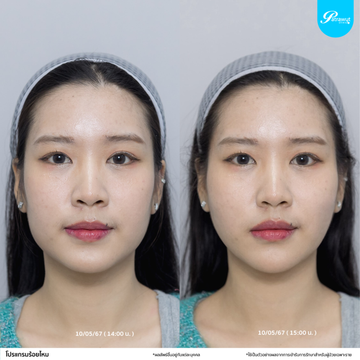 patrawutclinic-ร้อยไหม05