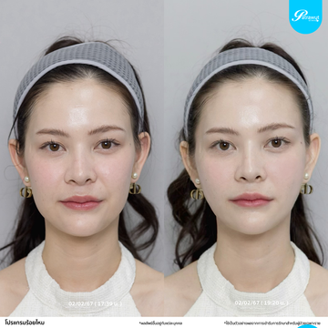 patrawutclinic-ร้อยไหม06