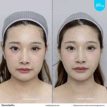 patrawutclinic-ร้อยไหม08