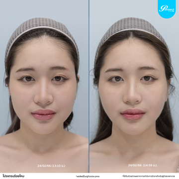patrawutclinic-ร้อยไหม10