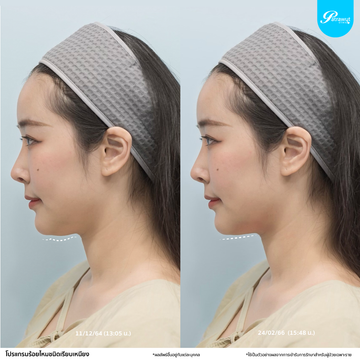 patrawutclinic-ร้อยไหมเหนียงเล็ก04