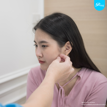 patrawutclinic-ร้อยไหมแก้มเล็ก02