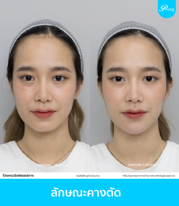 patrawutclinic-ลักษณะคางที่ควรฉีดฟิลเลอร์-01