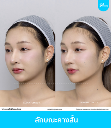 patrawutclinic-ลักษณะคางที่ควรฉีดฟิลเลอร์-02