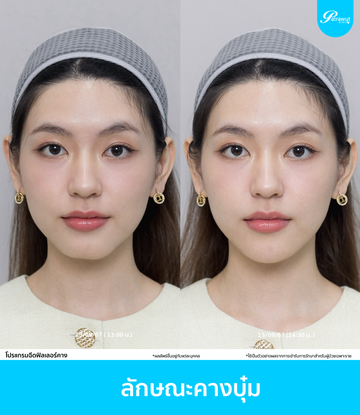 patrawutclinic-ลักษณะคางที่ควรฉีดฟิลเลอร์-03