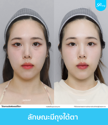 patrawutclinic-ลักษณะใต้ตา-01-01