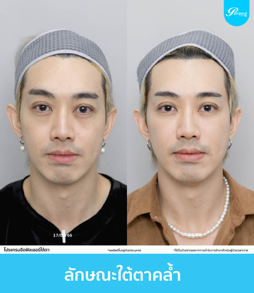 patrawutclinic-ลักษณะใต้ตา-01-02