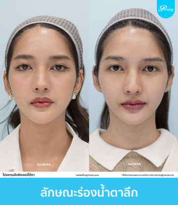 patrawutclinic-ลักษณะใต้ตา-01-03