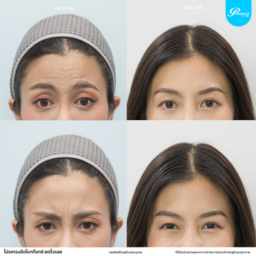 patrawutclinic-หน้าผากย่น:ตีนกา