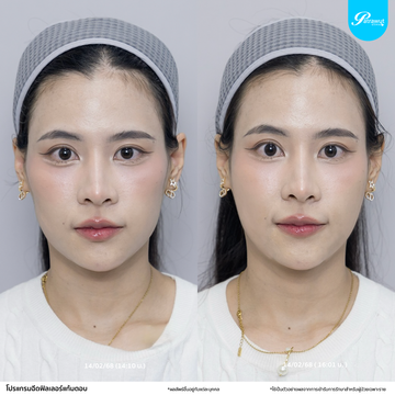 patrawutclinic-แก้มตอบ05