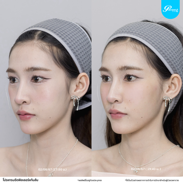patrawutclinic-แก้มส้ม03