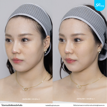 patrawutclinic-แก้มส้ม04
