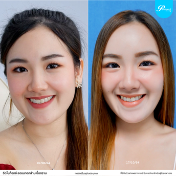 patrawutclinic-โบท็อกซ์-กราม04
