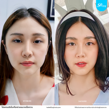 patrawutclinic-โบท็อกซ์-กราม06