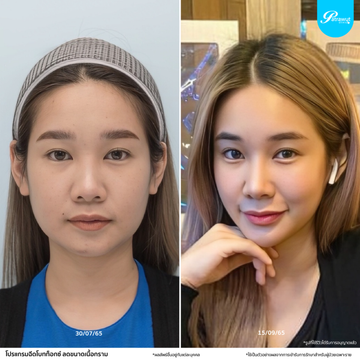 patrawutclinic-โบท็อกซ์-กราม07