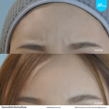 patrawutclinic-โบท็อกซ์-ริ้วรอย02