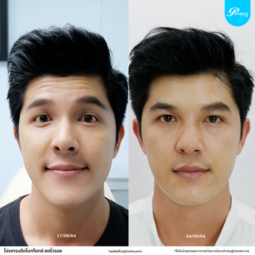 patrawutclinic-โบท็อกซ์-ริ้วรอย03