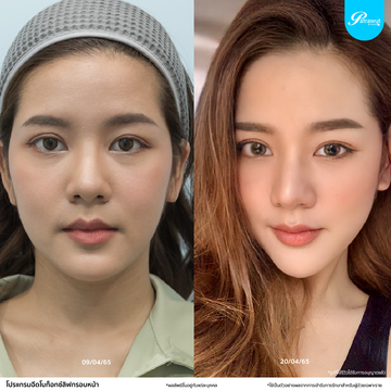 patrawutclinic-โบท็อกซ์ลิฟกรอบหน้า01