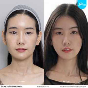 patrawutclinic-โบท็อกซ์ลิฟกรอบหน้า02