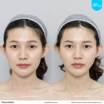 patrawutclinic-ใครควรร้อยไหม
