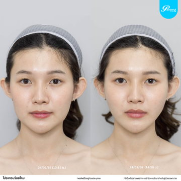 patrawutclinic-ใครควรร้อยไหม