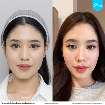 โบท็อกซ์-กราม02