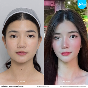 โบท็อกซ์-กราม03