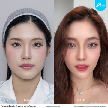 โบท็อกซ์-กราม