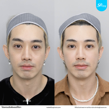 โปรแกรมฟิลเลอร์-คล้ำใต้ตา03
