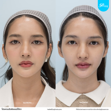 โปรแกรมฟิลเลอร์-ร่องใต้ตา01