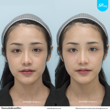 โปรแกรมฟิลเลอร์-ร่องใต้ตา02png
