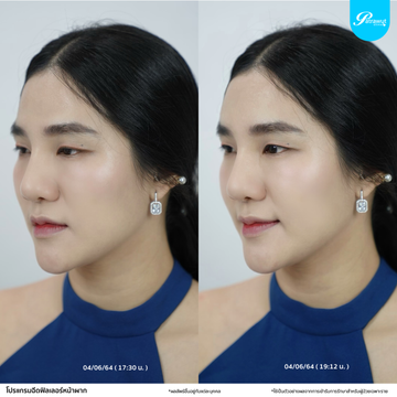 โปรแกรมฟิลเลอร์-หน้าผาก02