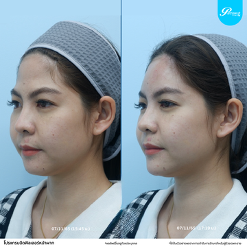 โปรแกรมฟิลเลอร์-หน้าผาก03