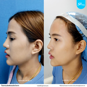 โปรแกรมฟิลเลอร์-หน้าผาก04