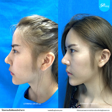 โปรแกรมฟิลเลอร์-หน้าผาก9