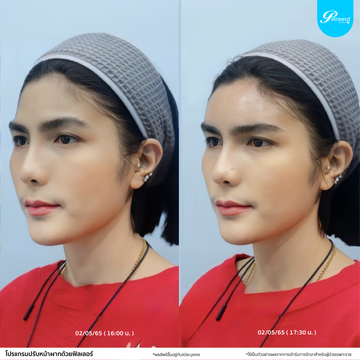 โปรแกรมฟิลเลอร์-หน้าผาก