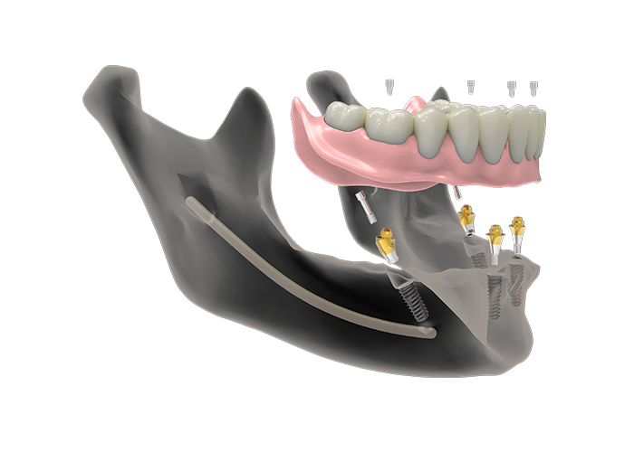 Multi-Unit-Abutment