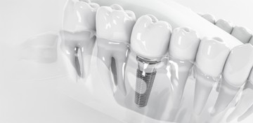 dentis-th(2)