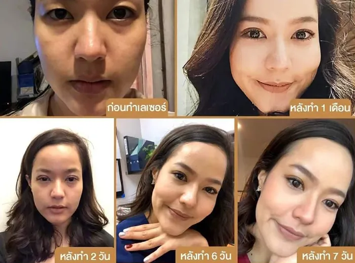 การทำตาไม่ต้องพักฟื้น-จริงหรือ