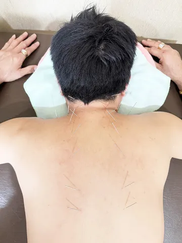 การฝังเข็ม2