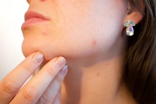 acne-16067651280