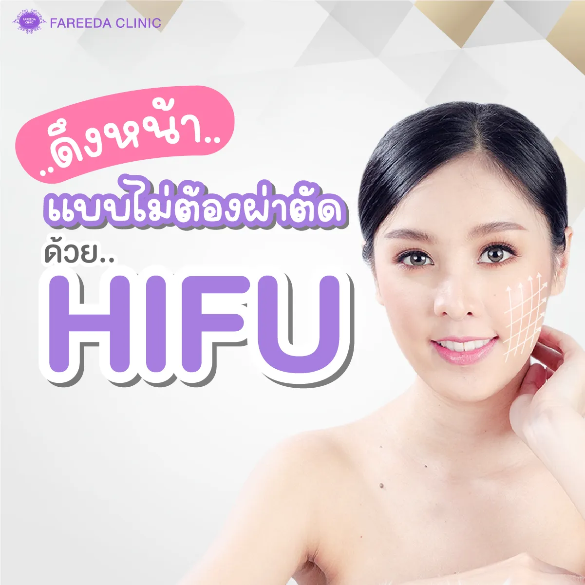 ดึงหน้าแบบไม่ต้องผ่าตัดด้วยHIFU