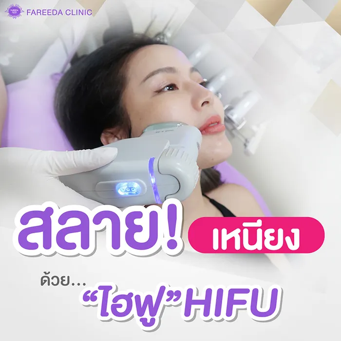สลายเหนียงด้วย-ไฮฟู-(Hifu)