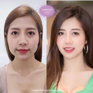 รีวิว-HIFU-(ไฮฟู)--แฟตแก้ม