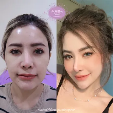 รีวิว-ฟิลเลอร์ปรับรูปหน้า-8-cc