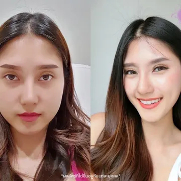 รีวิว-ลดกราม--แฟตแก้ม-แฟตเหนียง-2